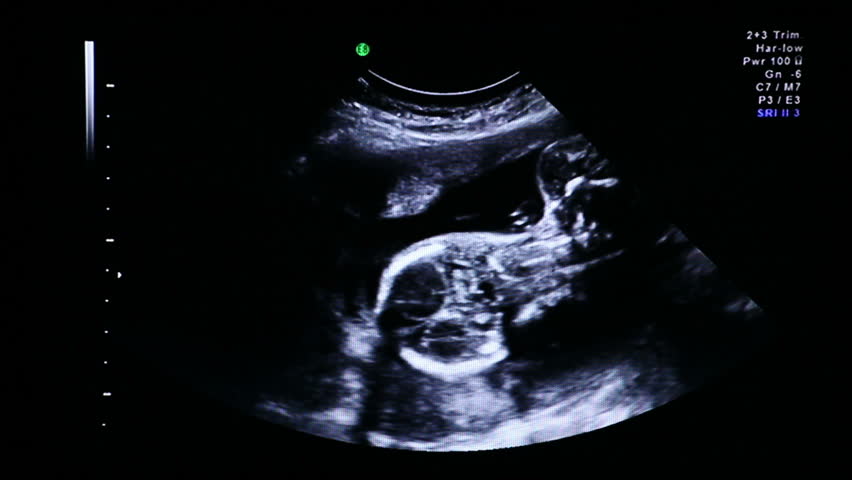Ultrasound echography. Gynaecological medical examination. 22 weeks old pregnancy. Baby's head measuring.