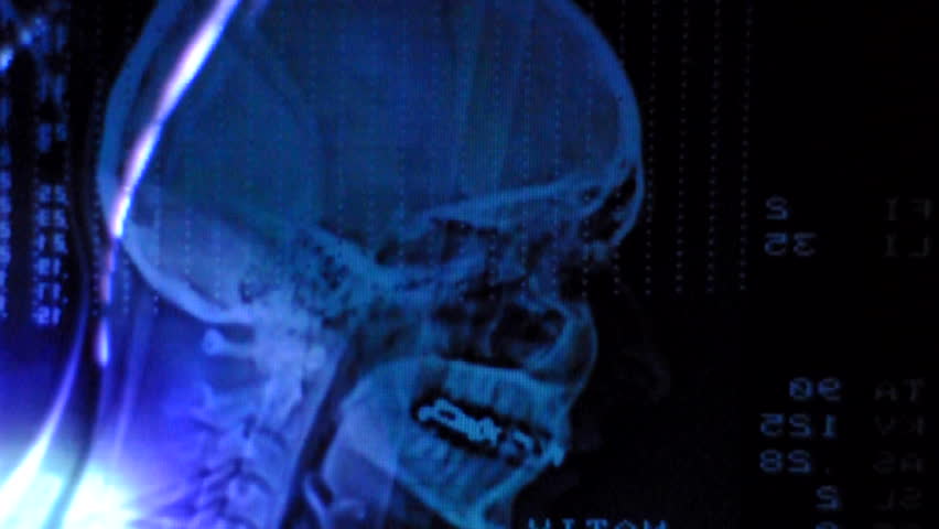 Closeup of a CT scan with flourish and skull on it and with rays 