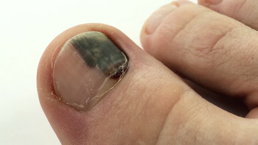 Blood Spot On Big Toe