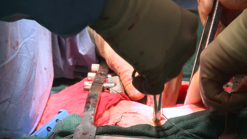Tubes being positioned during open heart surgery