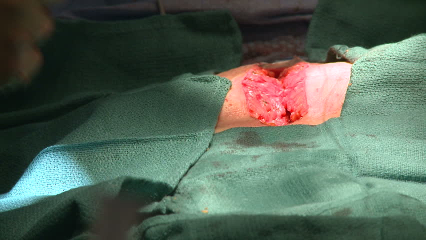 Surgeon stitching up abdomen