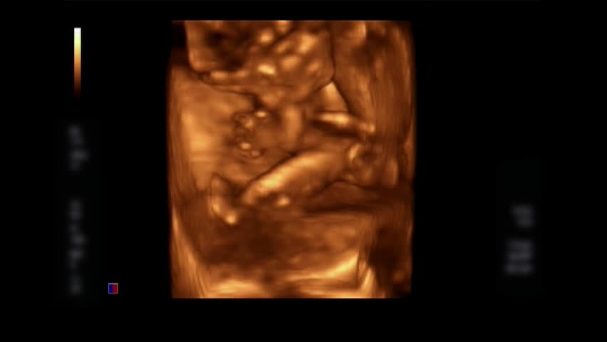 Header of 3D ultrasound