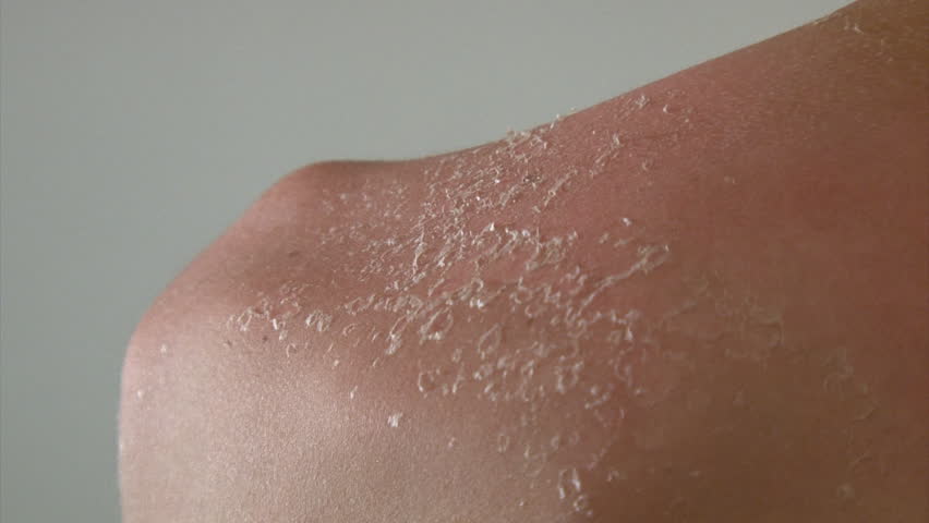 Boy peeling skin