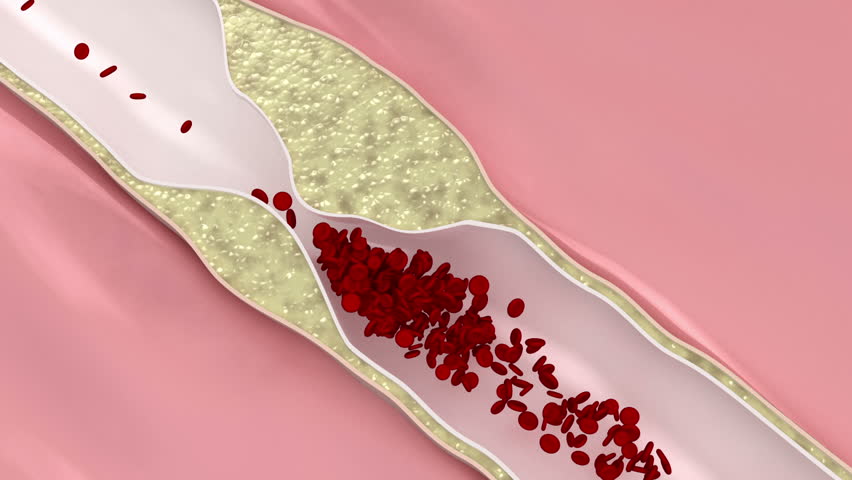 Coronary atherosclerosis disease