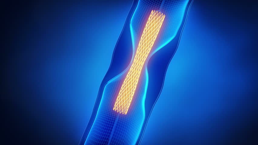 Angioplasty with stent catheter x-ray look