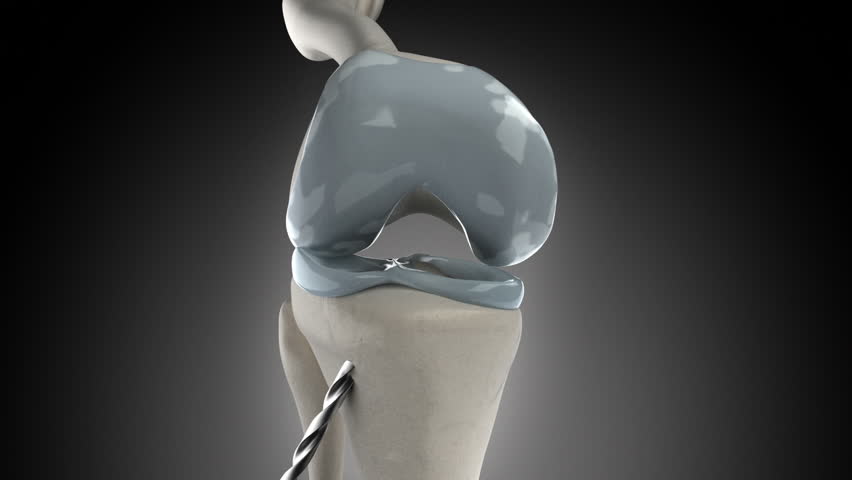 Knee arthroscopic cruciate ligament replacement stage