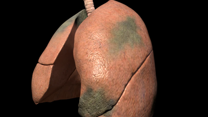 Spinning pan of human lungs highlighting the necrotic tissue in right and left lung lobes as a result of lung damage from emphysema or smoking