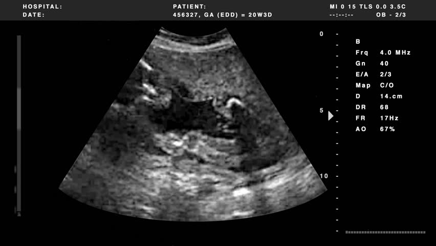 Video out put from an ultrasound combined with graphics.
