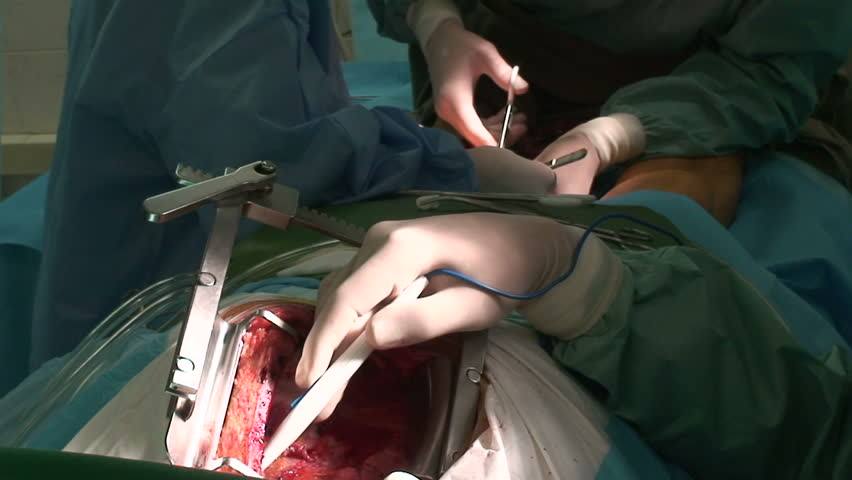 Cardiac surgery. Coronary bypass grafting.