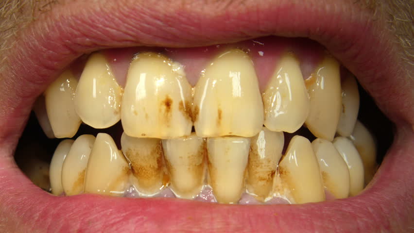 Image result for stains on teeth
