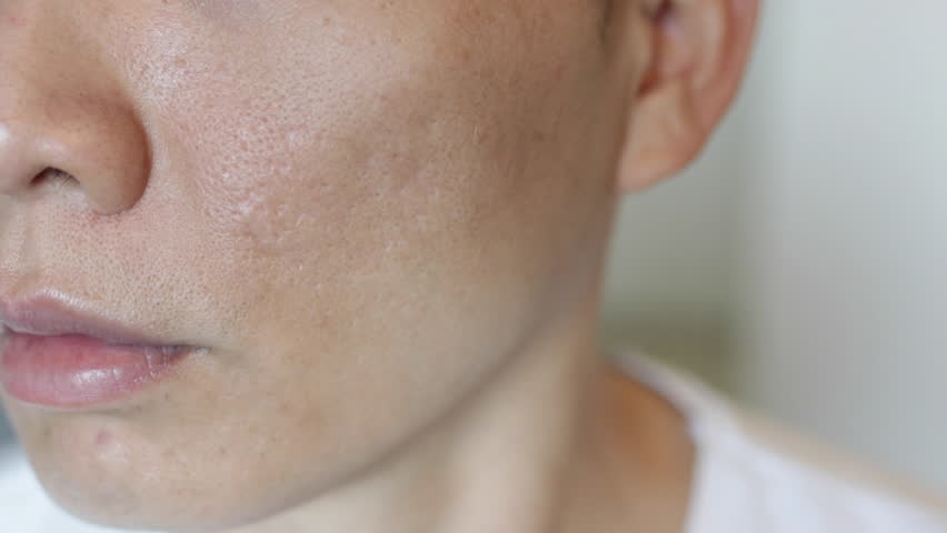Image result for acne scars on face