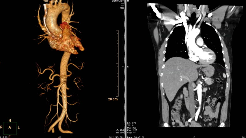 к т аорты. к т аорты. магнитно-резонансная ангиография аорты. разрыв аневризма брюшной аорты на кт. расслаивающая аневризма брюшной аорты кт.