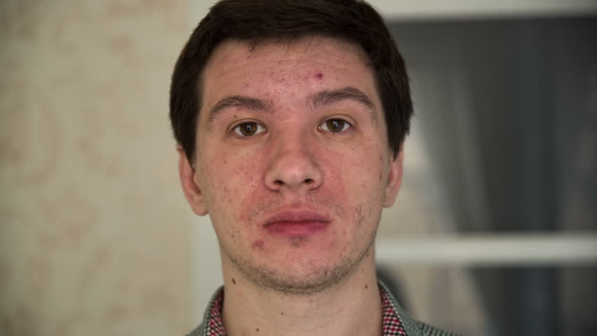 Acne On A Face Of A Man Stock Footage Video 14179826 | Shutterstock