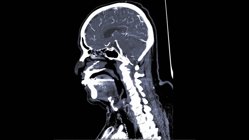 Стоковое видео «Computed Tomography Angiography, Cta Brain ...