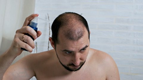 Hair Loss Cure Stock Video Footage 4k And Hd Video Clips