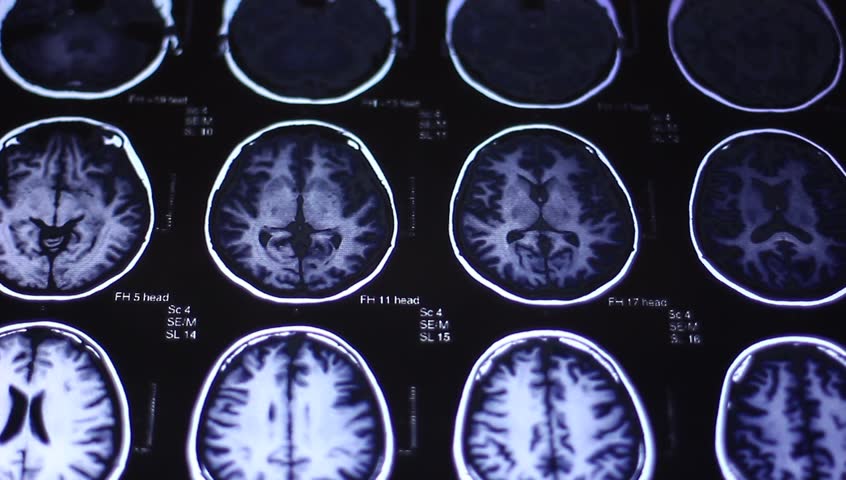 MRI Brain Scan Stock Footage Video 965296 | Shutterstock