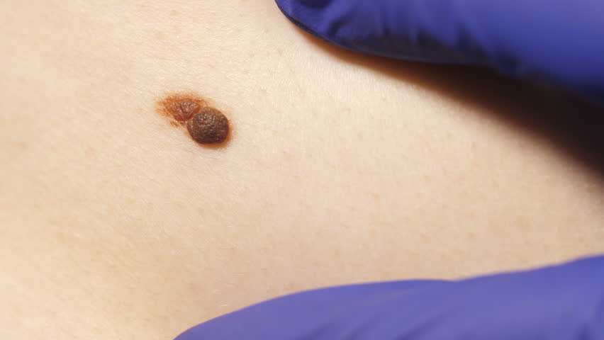Header of birthmark