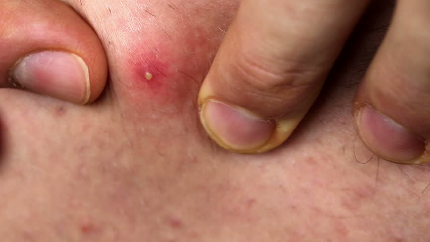 Header of pimple